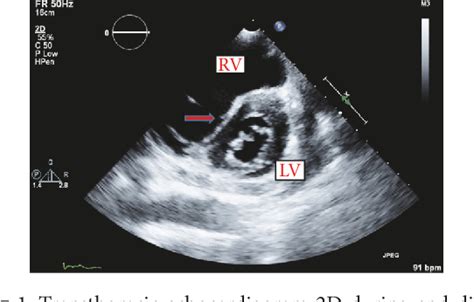 d shaped left ventricular dysfunction